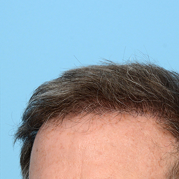 Fue Before and After | Dr. Jeffrey Wise