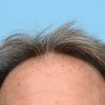Fue Before and After | Dr. Jeffrey Wise