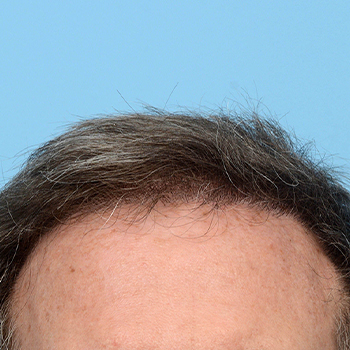 Fue Before and After | Dr. Jeffrey Wise