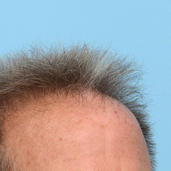 Fue Before and After | Dr. Jeffrey Wise