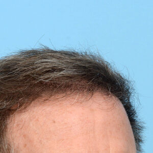 Fue Before and After | Dr. Jeffrey Wise