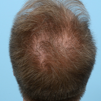 Fue Before and After | Dr. Jeffrey Wise