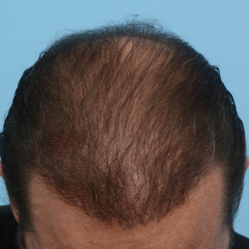 Fue Before and After | Dr. Jeffrey Wise