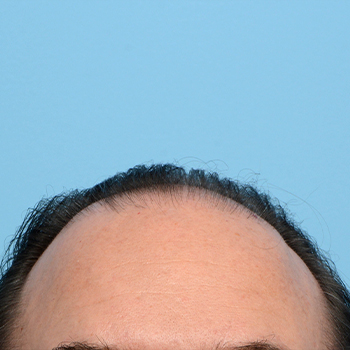 Fue Before and After | Dr. Jeffrey Wise
