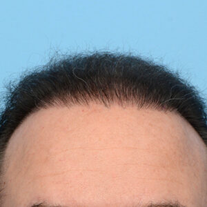Fue Before and After | Dr. Jeffrey Wise