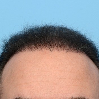 Fue Before and After | Dr. Jeffrey Wise