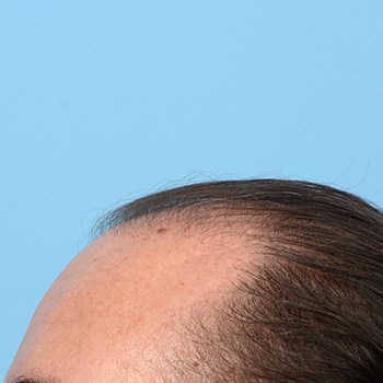 Fue Before and After | Dr. Jeffrey Wise