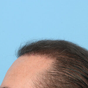Fue Before and After | Dr. Jeffrey Wise