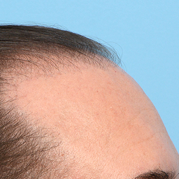 Fue Before and After | Dr. Jeffrey Wise