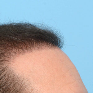 Fue Before and After | Dr. Jeffrey Wise