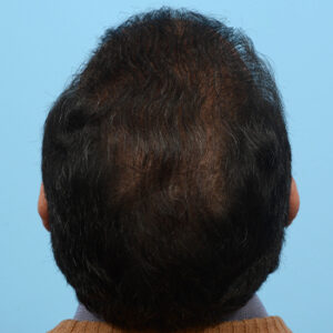 Fue Before and After | Dr. Jeffrey Wise