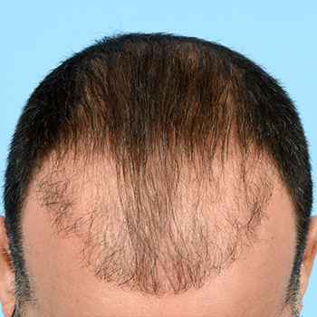 Fue Before and After | Dr. Jeffrey Wise
