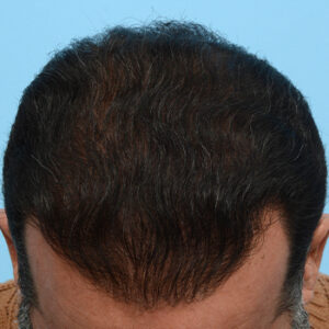 Fue Before and After | Dr. Jeffrey Wise