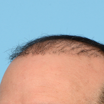 Fue Before and After | Dr. Jeffrey Wise