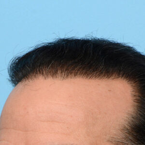 Fue Before and After | Dr. Jeffrey Wise