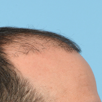 Fue Before and After | Dr. Jeffrey Wise