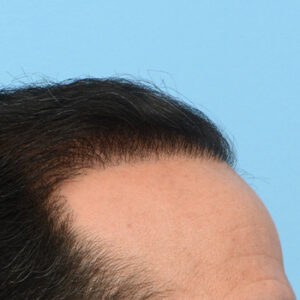 Fue Before and After | Dr. Jeffrey Wise