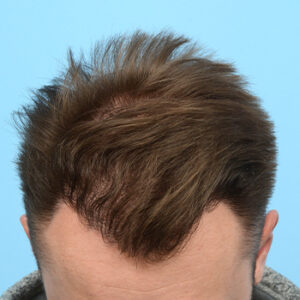 Fue Before and After | Dr. Jeffrey Wise