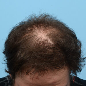 Fue Before and After | Dr. Jeffrey Wise