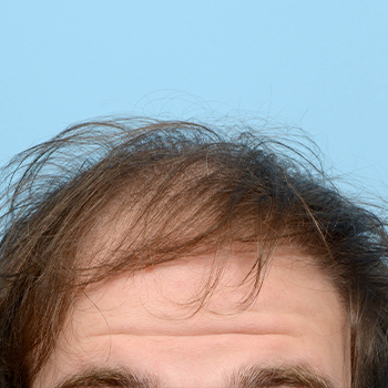 Fue Before and After | Dr. Jeffrey Wise