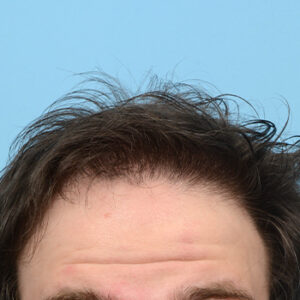 Fue Before and After | Dr. Jeffrey Wise