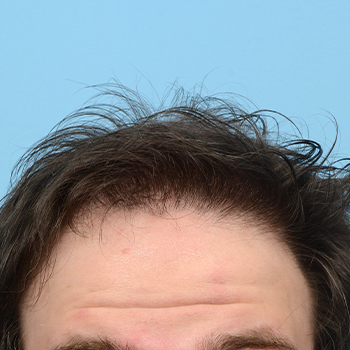 Fue Before and After | Dr. Jeffrey Wise