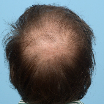 Fue Before and After | Dr. Jeffrey Wise