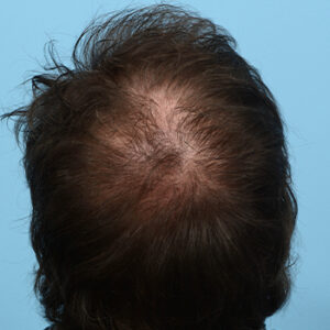Fue Before and After | Dr. Jeffrey Wise