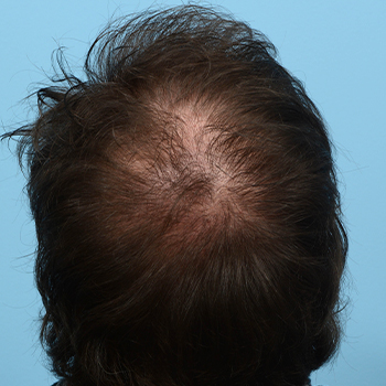 Fue Before and After | Dr. Jeffrey Wise