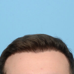 Fue Before and After | Dr. Jeffrey Wise
