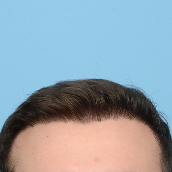 Fue Before and After | Dr. Jeffrey Wise