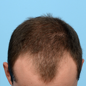 Fue Before and After | Dr. Jeffrey Wise