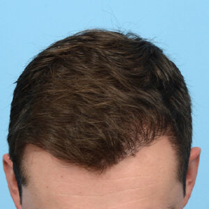 Fue Before and After | Dr. Jeffrey Wise