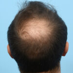 Fue Before and After | Dr. Jeffrey Wise