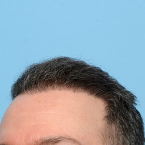 Fue Before and After | Dr. Jeffrey Wise