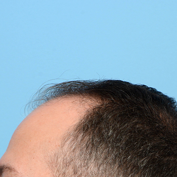 Fue Before and After | Dr. Jeffrey Wise