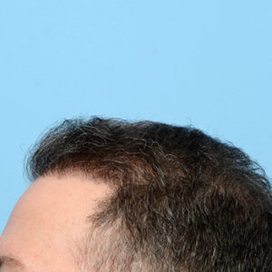 Fue Before and After | Dr. Jeffrey Wise