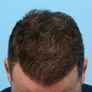 Fue Before and After | Dr. Jeffrey Wise