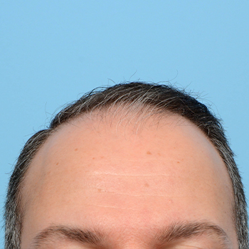 Fue Before and After | Dr. Jeffrey Wise