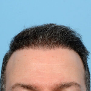 Fue Before and After | Dr. Jeffrey Wise