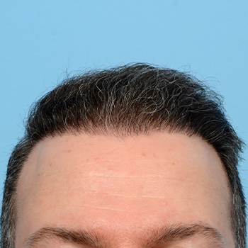 Fue Before and After | Dr. Jeffrey Wise