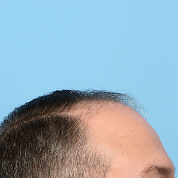 Fue Before and After | Dr. Jeffrey Wise