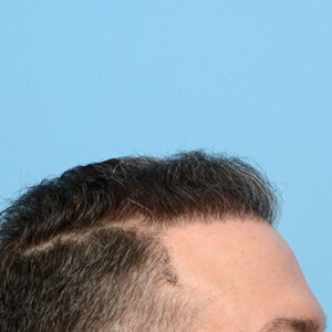 Fue Before and After | Dr. Jeffrey Wise