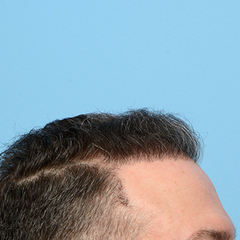 Fue Before and After | Dr. Jeffrey Wise