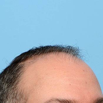 Fue Before and After | Dr. Jeffrey Wise