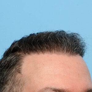 Fue Before and After | Dr. Jeffrey Wise
