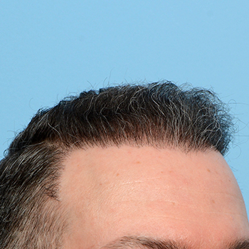 Fue Before and After | Dr. Jeffrey Wise