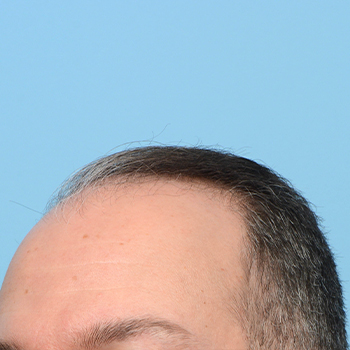 Fue Before and After | Dr. Jeffrey Wise
