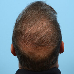 Fue Before and After | Dr. Jeffrey Wise