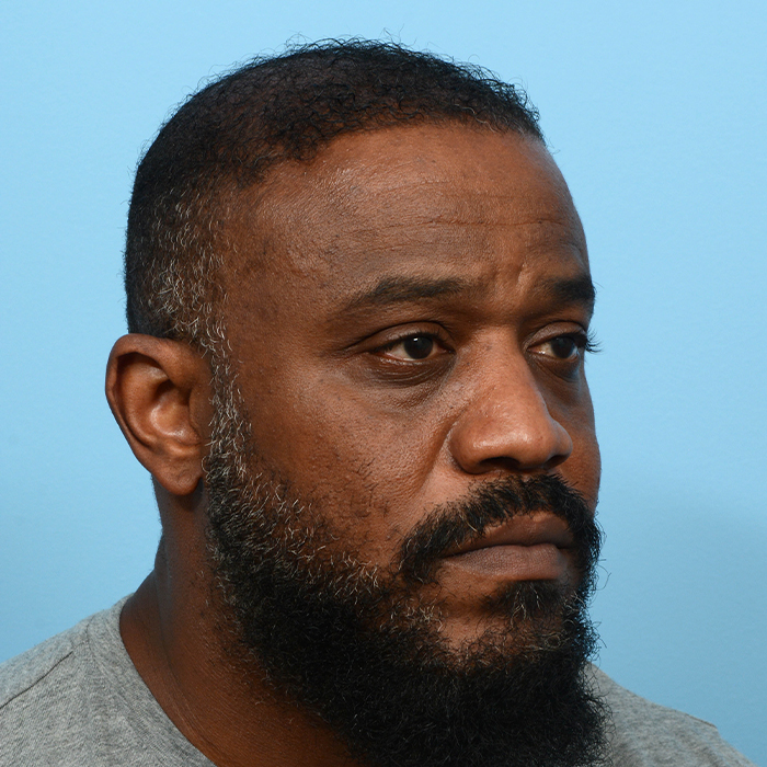 Fue Before and After | Dr. Jeffrey Wise